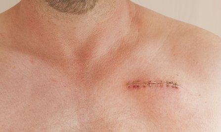 Le traitement des cicatrices : méthodes, innovations et perspectives cicatrices